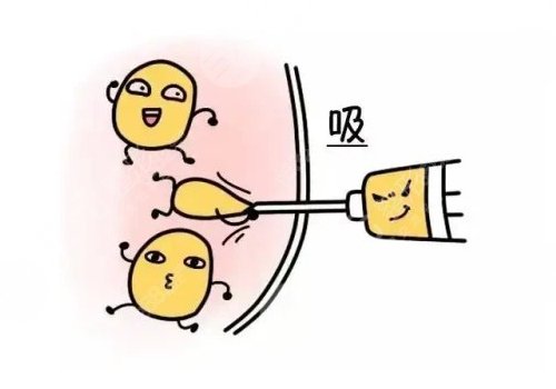 吸脂凹凸不平多久恢復？