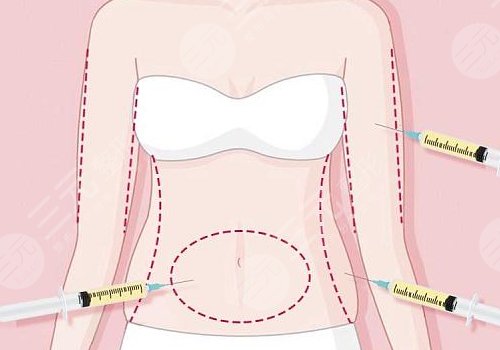 吸脂凹凸不平多久恢復？