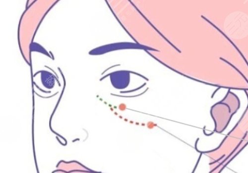 雙美膠原蛋白填充淚溝能維持多久？