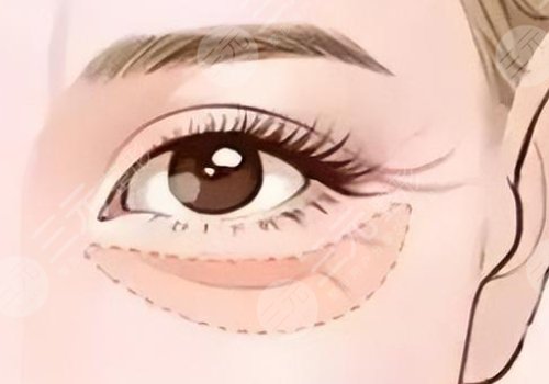 雙美膠原蛋白填充淚溝能維持多久？