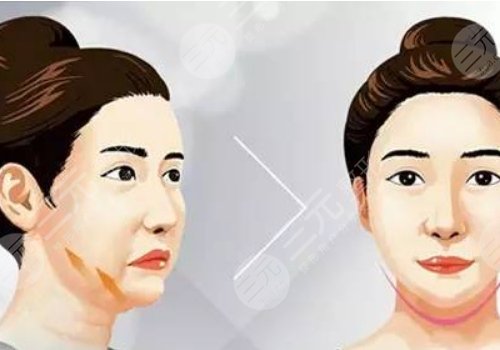 下頜緣提升有什么效果？