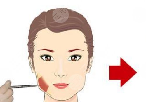 下頜緣提升有什么效果？