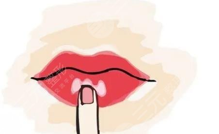 m唇整形一般多久拆線？術(shù)前小科普，這3件事你該了解！