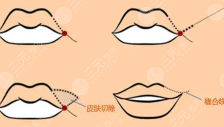 下唇厚外翻整形手術(shù)怎么做？科普及費(fèi)用價(jià)格參考！