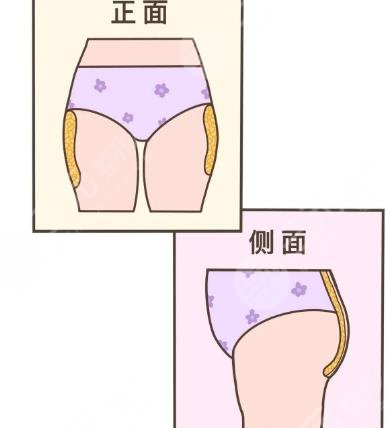 臀部?jī)蓚?cè)凸起怎么整形？吸脂體雕助你矯正不美臀型！