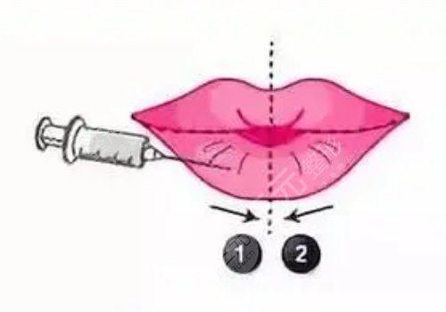 玻尿酸豐唇多久消腫？能維持多久？
