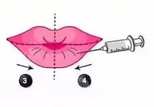 玻尿酸豐唇多久消腫？能維持多久？