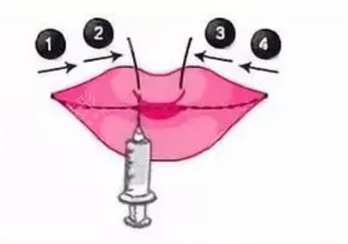 玻尿酸豐唇多久消腫？能維持多久？