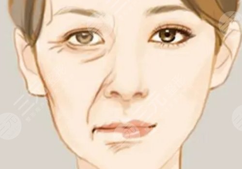 括號紋怎么去掉？怎么形成的？改良方式解讀！