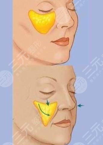 北京亞韓王鳳芹專家脂肪填充面部案例