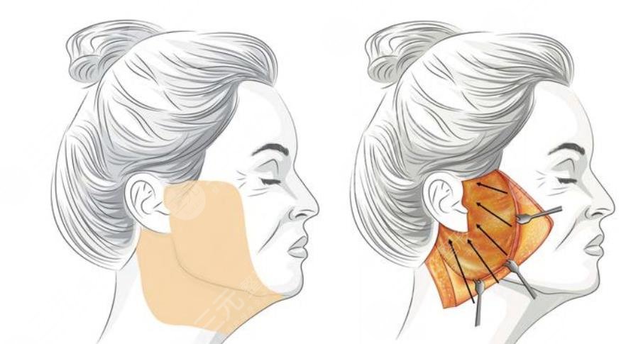 吳佳君醫(yī)生拉皮真實(shí)案例