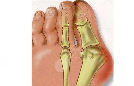 大腳骨怎么緩解比較好?