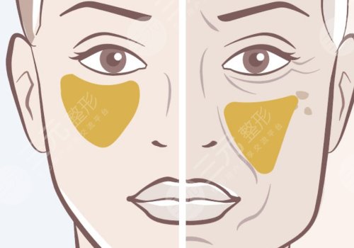 蘋果肌斷層有啥辦法解決？