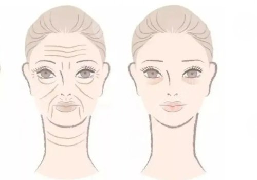 抬頭紋去除手術(shù)需要多少錢？