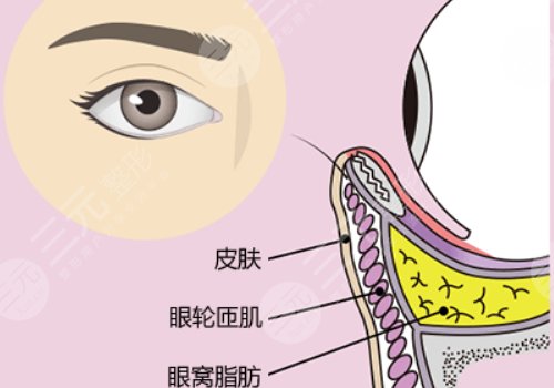 眼窩凹陷用什么填充好？
