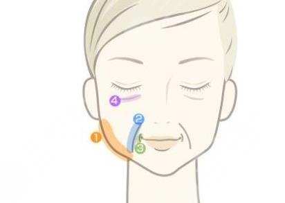 面部提升