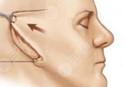 筋膜懸吊術(shù)適合多大年齡的？