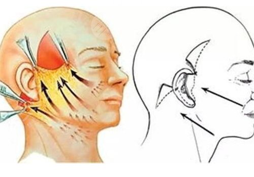 筋膜懸吊術(shù)適合多大年齡的？