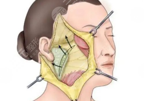 筋膜懸吊術(shù)適合多大年齡的？