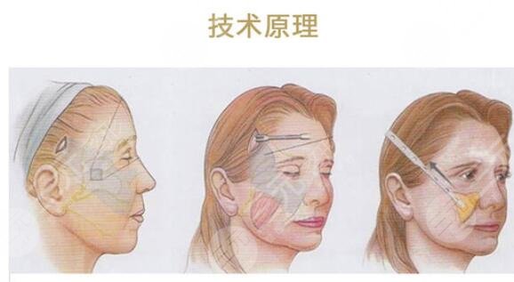 謝宏彬醫(yī)生拉皮案例介紹