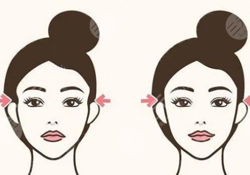 膠原蛋白填充太陽凹大概多少錢？