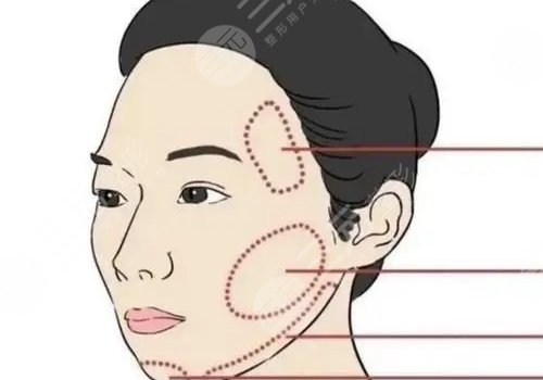 輪廓固定提升多少錢做一次好？