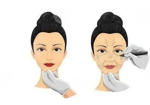 輪廓固定提升多少錢做一次好？