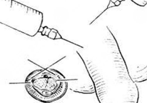 玻尿酸男性增大注射要多少錢？