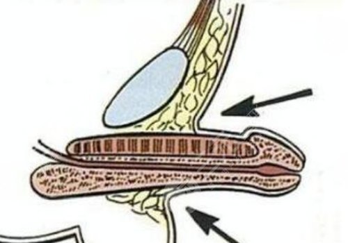 玻尿酸男性增大注射要多少錢？