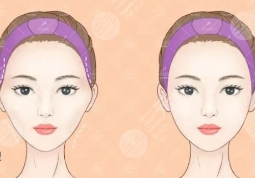 假體填充太陽凹大概多少錢？