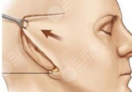 面部提升術(shù)的危害有什么？