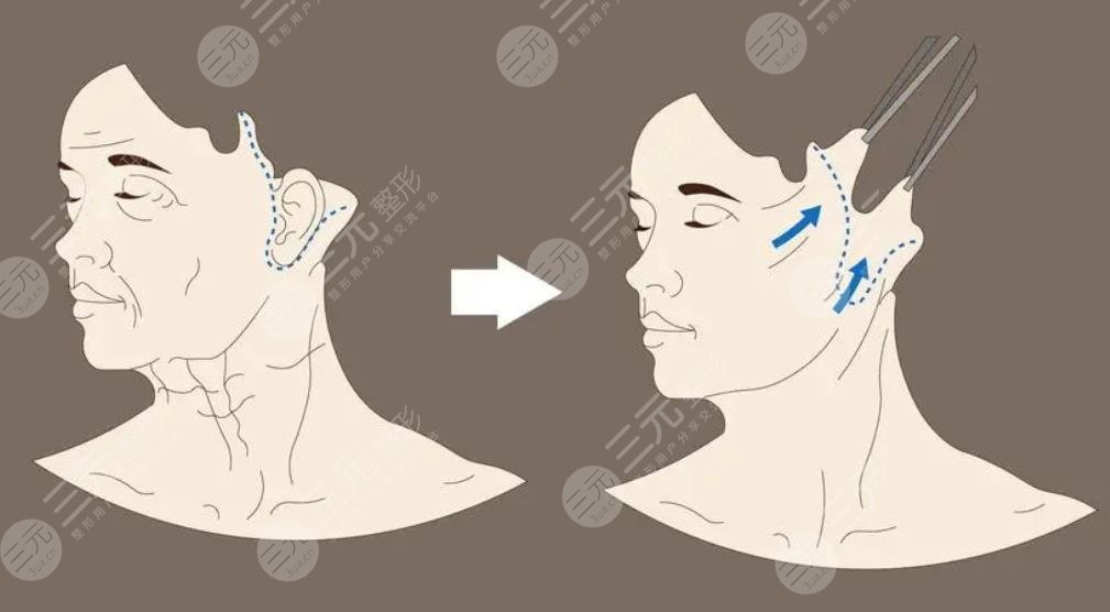 侯典舉醫(yī)生拉皮手術(shù)案例