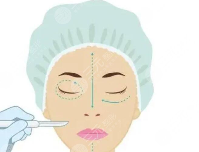 內(nèi)輪廓固定