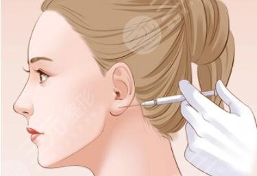 內(nèi)輪廓固定外輪廓固定