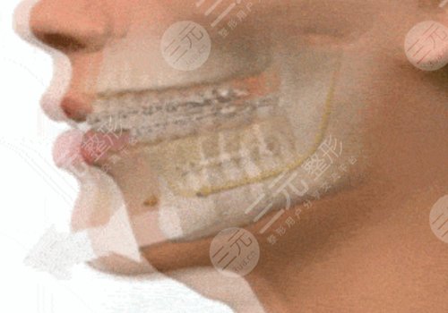 臉部骨骼變形能矯正嗎？