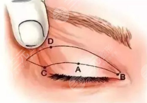做眼部提拉手術(shù)能維持多久？