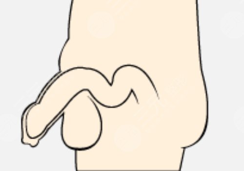 男人增長手術(shù)大概需要多少錢？