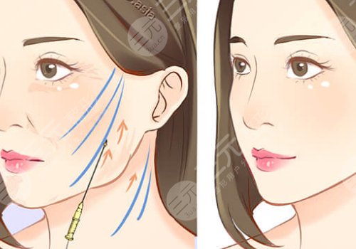 臉部提拉緊致手術(shù)多少錢(qián)？