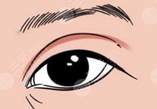 怎么做雙眼皮自然？