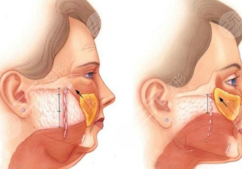 筋膜懸吊提升術能保持多久