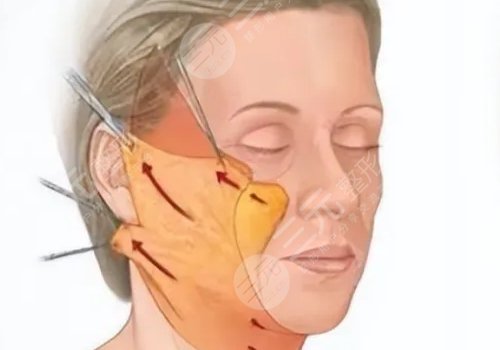 筋膜懸吊提升術能保持多久