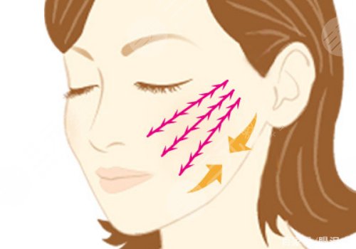 筋膜懸吊提升術能保持多久