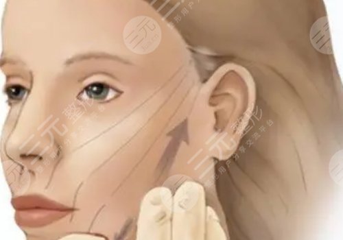 筋膜懸吊提升術能保持多久