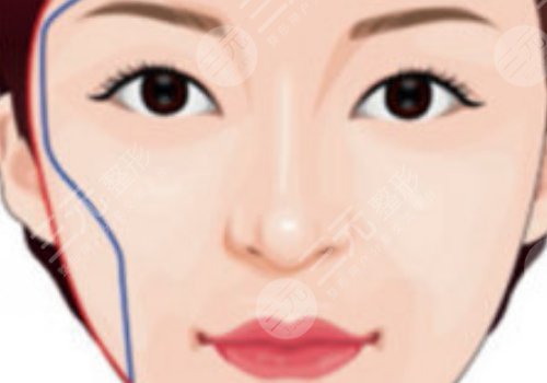 面部輪廓固定怎么做？