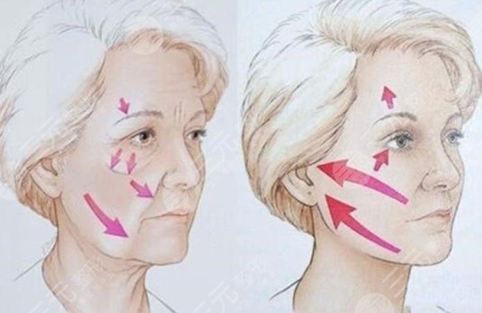 王翼耕拉皮手術案例