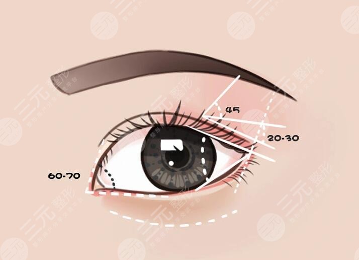 陳貴宗醫(yī)生雙眼皮修復案例