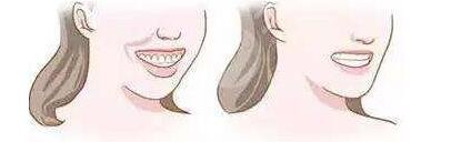 上海九院口腔科牙齒正畸案例