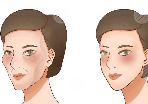 凹陷修復(fù)多少錢一個(gè)坑？