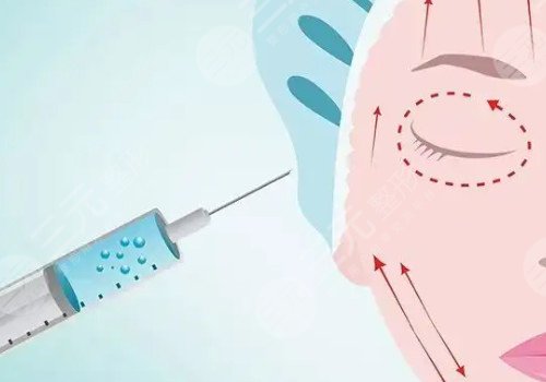 瑞藍玻尿酸打在哪個部位？