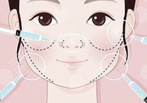 瑞藍玻尿酸打在哪個部位？